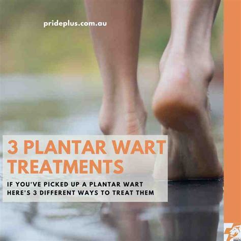 How To Treat Your Plantar Wart | 3 Podiatrist Approved Options