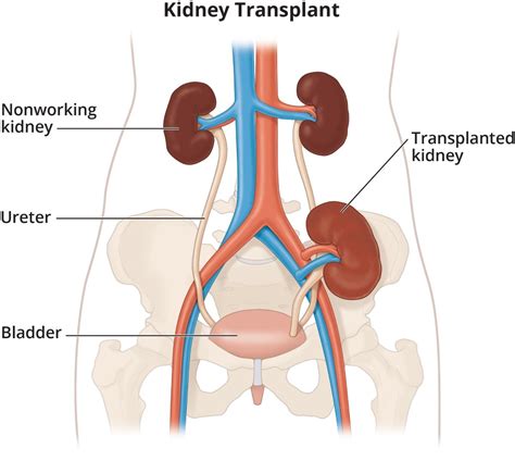 Kidney Transplantation Procedure and information about donor and recipient - HubPages