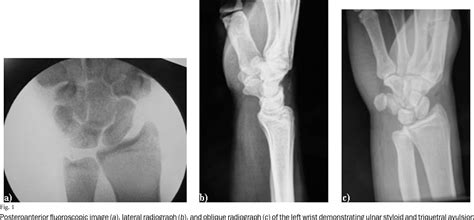 Dislocated wrist | Semantic Scholar