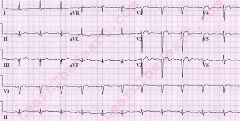 ECG Case #12 - Question #1 Answer | LearntheHeart.com