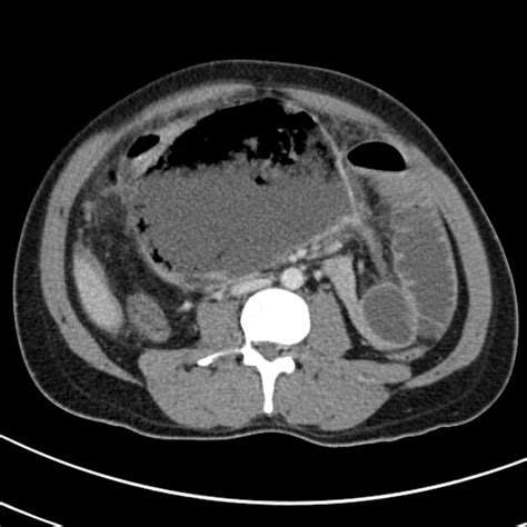 Gastrointestinal perforation CT - wikidoc