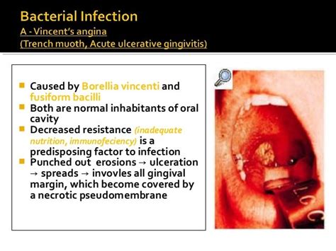 Vincent Angina Symptoms