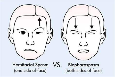 Hemifacial Spasm | Causes and Symptoms