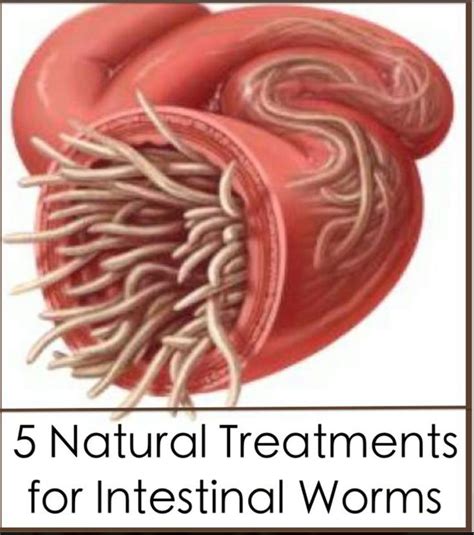 5 Natural Treatments for Intestinal Worms | Detox | Pinterest | Natural ...