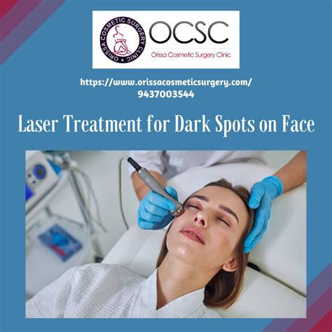 Laser Treatment for Dark Spots on Face - 1 | Laser treatment… | Flickr