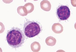 hairy cell leukemia