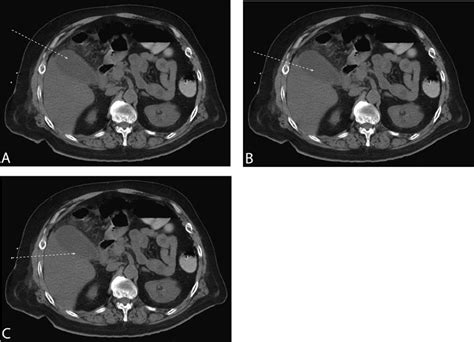 Percutaneous Cholecystostomy | Radiology Key