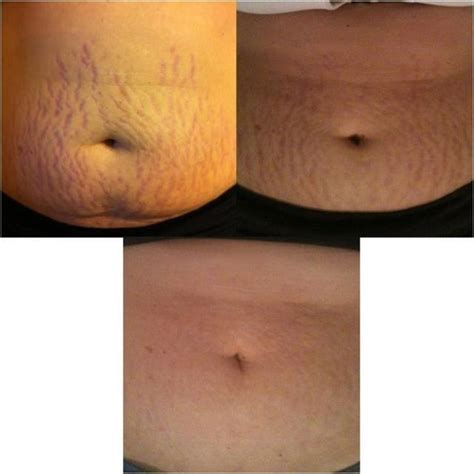 Got stretch marks? | It WORKS!! Before and after pictures | Pinterest ...