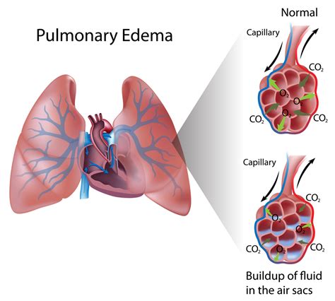 A New Mechanism to Prevent Pulmonary Edema in Severe Infections