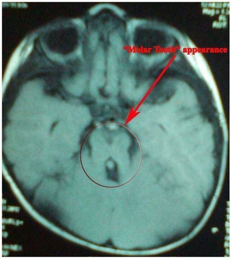 MRI brain showing deepening of the interpeduncular fossa, thickening of... | Download Scientific ...