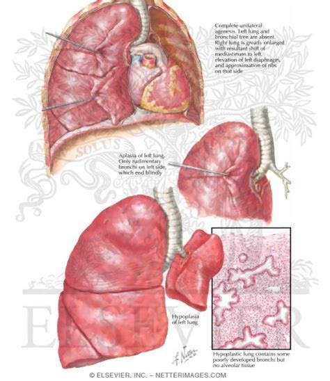 Pulmonary Agenesis, Aplasia, and Hypoplasia