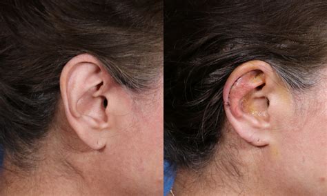 Earlobe Reduction For Large Prominent Ears | World Expert in Making ...