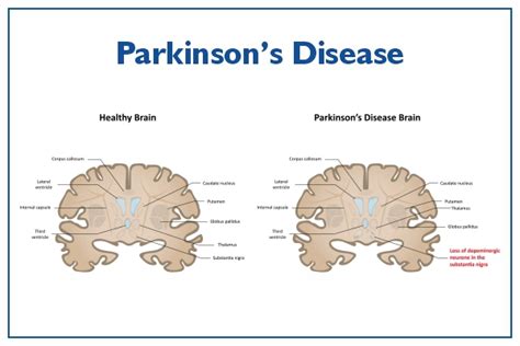 Parkinson's Disease symptoms