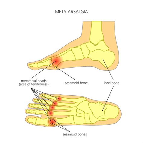 10 Symptoms of Metatarsalgia - Facty Health