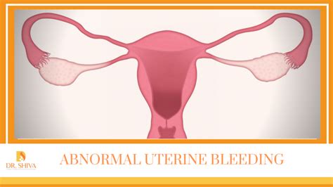 Abnormal Uterine Bleeding | Symptoms, Causes and Treatment | Dr. Shiva