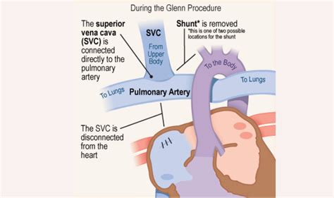 Understanding the Glenn Procedure: A Comprehensive Guide for Indian Patients | Vaidam Health