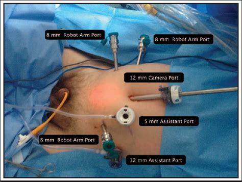 Figure 2 from Robot assisted radical prostatectomy: how I do it. Part I: Patient preparation and ...