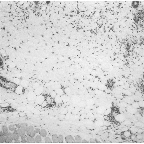 Histology of the Arthus reaction in skin, treated with PBS (positive... | Download Scientific ...