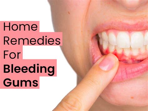 13 Effective Home Remedies For Bleeding Gums - Boldsky.com