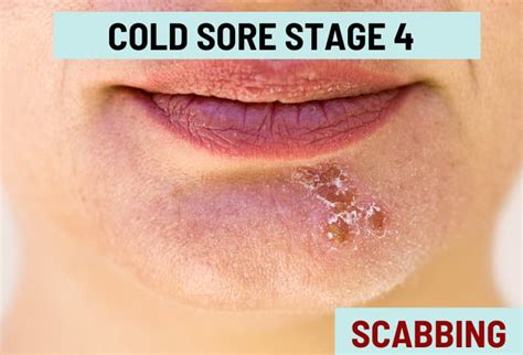 Cold Sore Stages, with Pictures