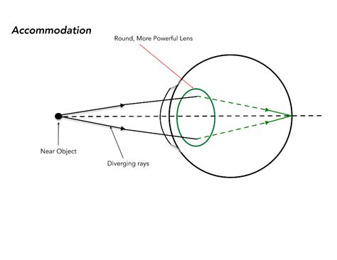 Moran CORE | Presbyopia