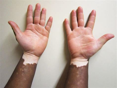 Vitiligo: Illustrated guide to pigmentation disorder