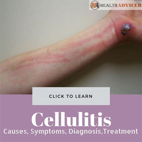 Cellulitis: Causes, Picture, Symptoms, Diagnosis And Treatment