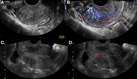 Uterine Cancer Ultrasound Images