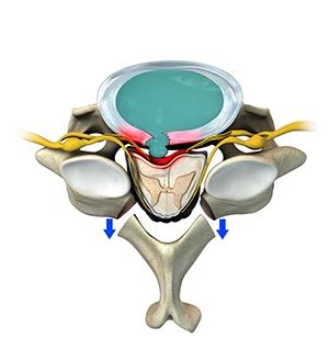 Posterior Cervical Laminectomy and Fusion | Advanced Orthopaedics ...