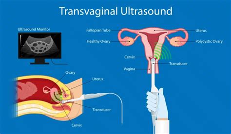 Polycystic Ovarian Syndrome (PCOS) in Singapore - Dr Ng Kai Lyn