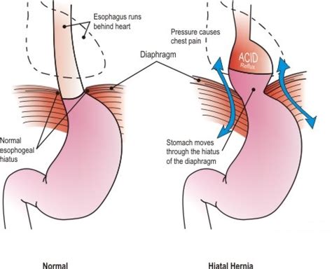 Hiatus Hernia Info: Signs & Symptoms of the Hiatus Hernia