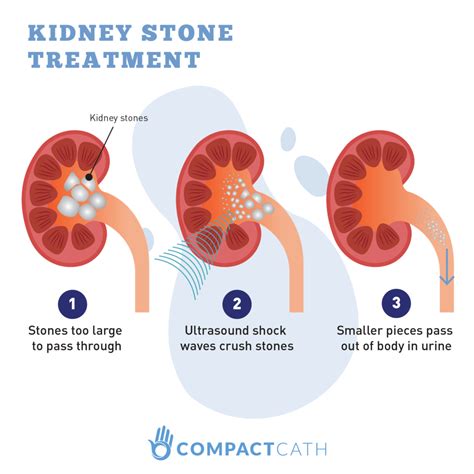 Kidney Stones: The Ultimate Beginner’s Guide - CompactCath