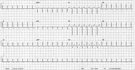 ECG of the Week 7th December 2022 | Emergucate