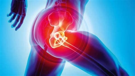 Hip Replacement Materials Best to Worst - BioXcellerator