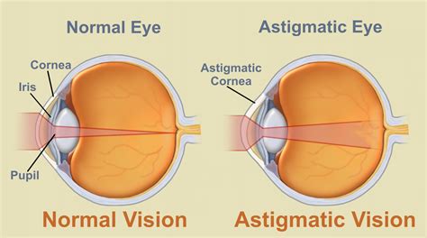 What is Astigmatism?