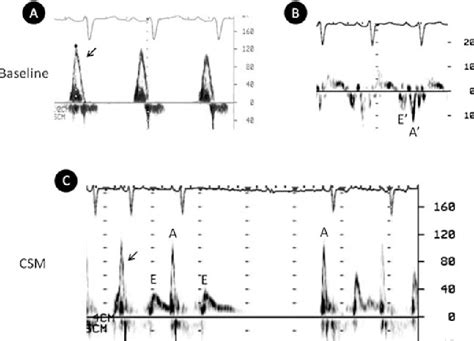 Carotid sinus massage in the echocardiography laboratory. | Semantic Scholar