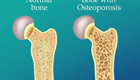 Osteoporosis: Causes, Symptoms and Treatment - Public Health Notes