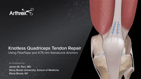 Arthrex - Knotless Quadriceps Tendon Repair Using FiberTape® and 4.75 ...