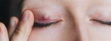 Swollen eyelids: what are the symptoms, causes and treatment options? | Lentiamo