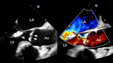 Case Report: Austin Flint Murmur and Phenomenon | Case Report: Austin Flint Murmur and ...