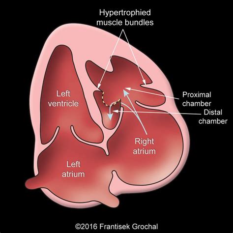 9 best Double Chamber Right Ventricle (DCRV) images on Pinterest | Baby ...