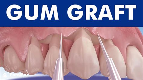 Gum graft - Coronally advanced flap - Receding gums treatment © - YouTube