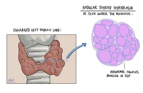 Types Of Thyroid Nodules