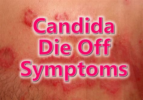 Candida Die Off Symptoms | Candida die off, Die off symptoms, Candida