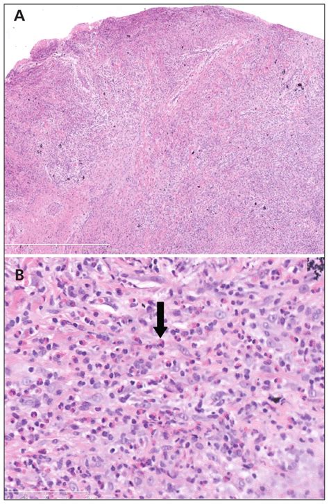 Eosinophilic gastroenteritis in a young man | CMAJ