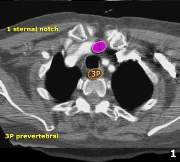 Mediastinal Lymph Nodes Map