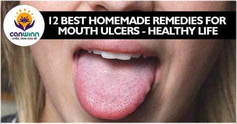 12 Best homemade remedies for mouth ulcers - Healthy Life - Canwinn