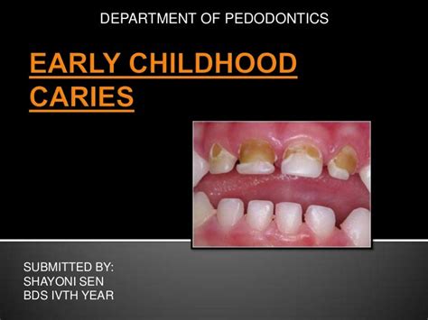 Early childhood caries