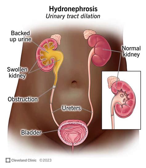 Hydronephrosis: Causes, Symptoms, Diagnosis Treatment, 43% OFF