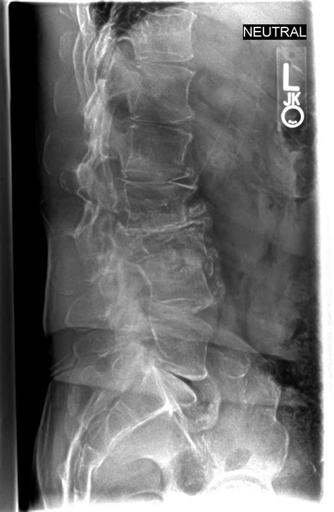 Lateral lumbar surgery for the treatment of degenerative lumbar ...